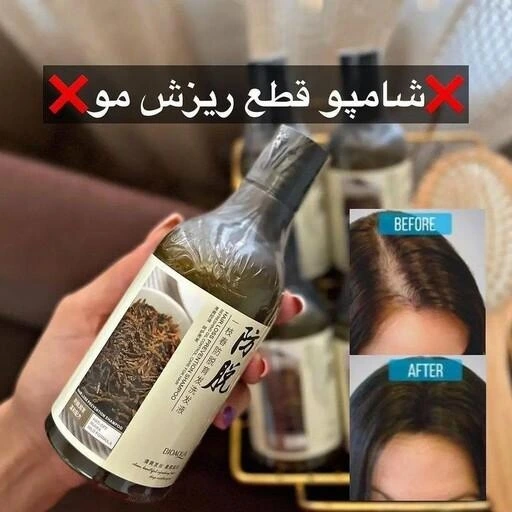 رفع شوره سر